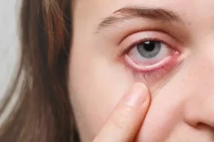 Mengenal Retinopati Diabetik, Penyakti Mata Akibat Diabetes